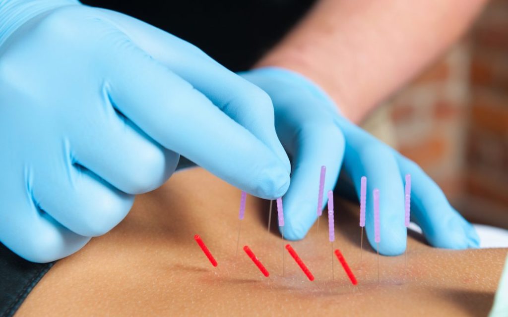 acupuntura, dry needling